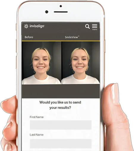 Invisalign Smile View Simulator